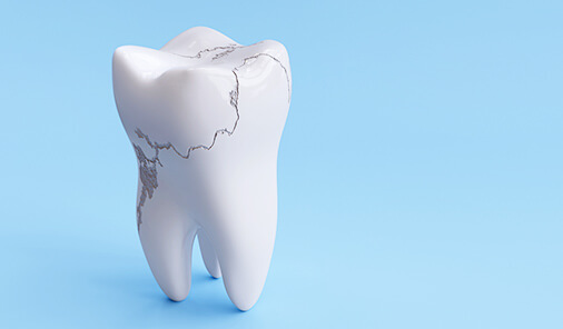 被せ物が「長持ち」する